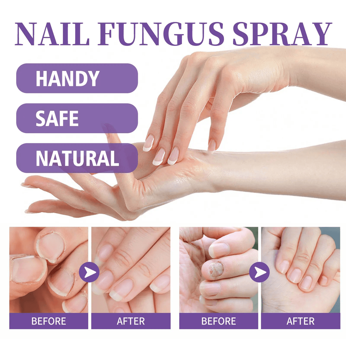 Extra Strong Nail Fungus Treatment Spray 100ml (رذاذ)